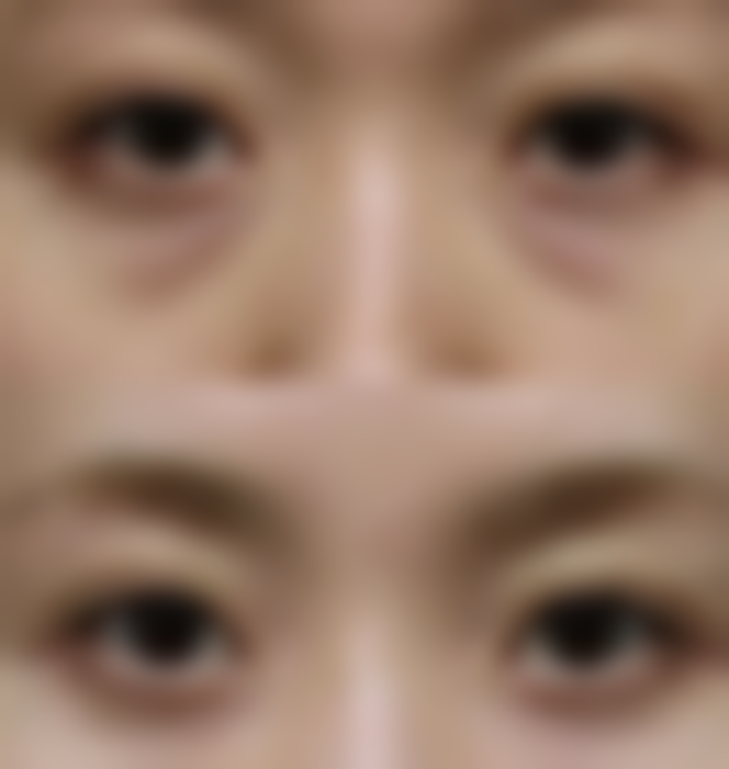 合肥维多利亚整形医院双眼皮效果：术前术后大对比