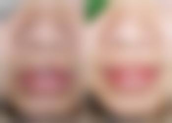 疤痕体质的人纹眉的术前术后注意事项