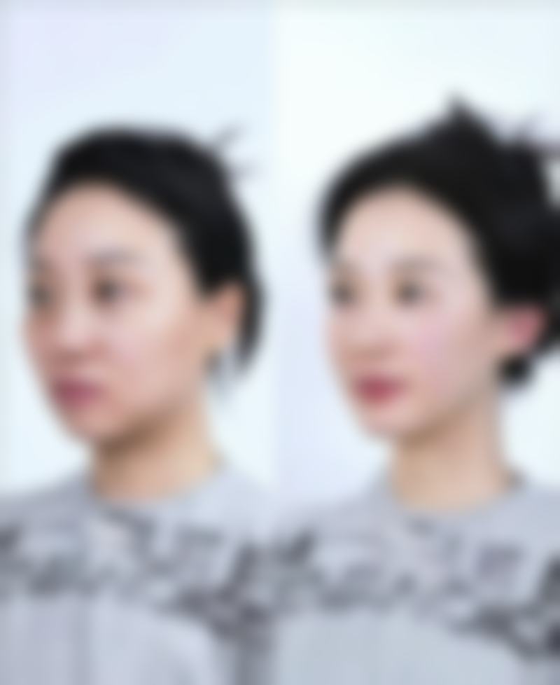 如何精细选择你的“本命”隆鼻材料