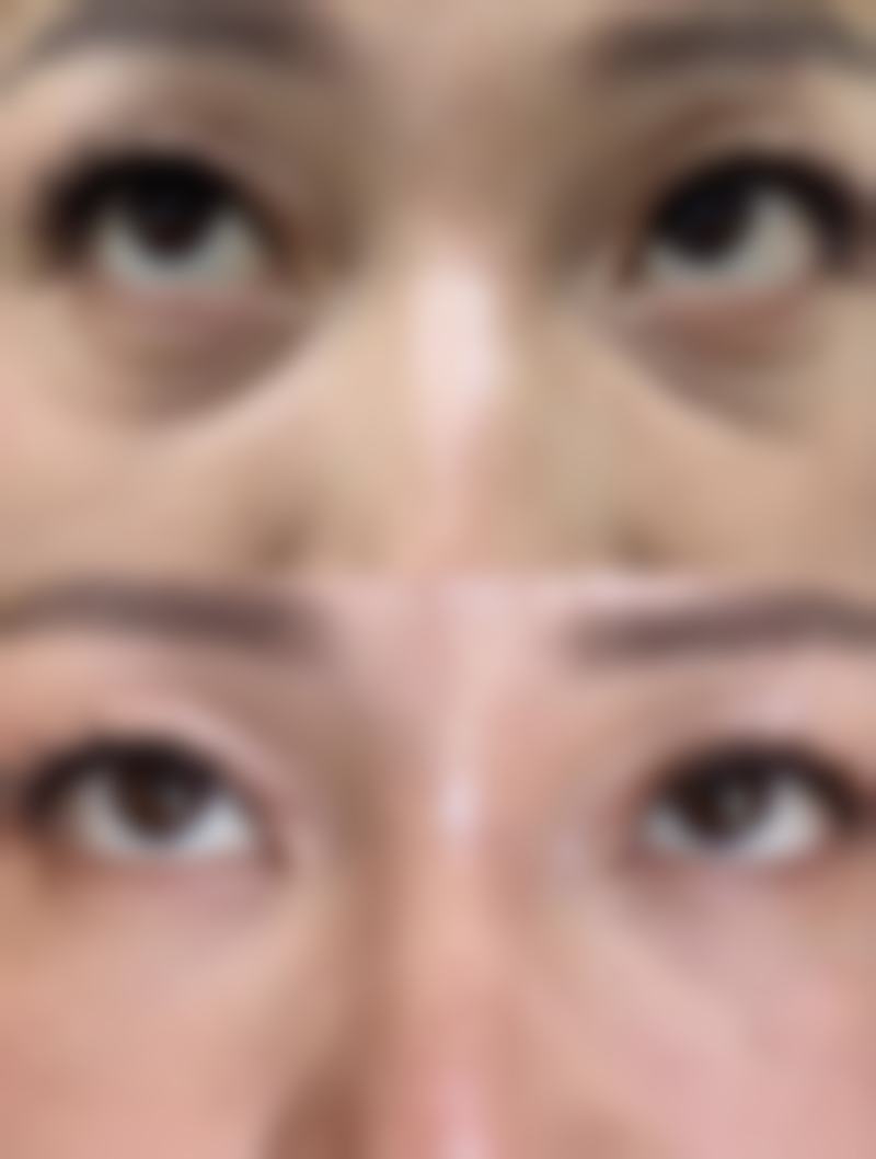 硅胶假体隆胸修复期能用手捏吗