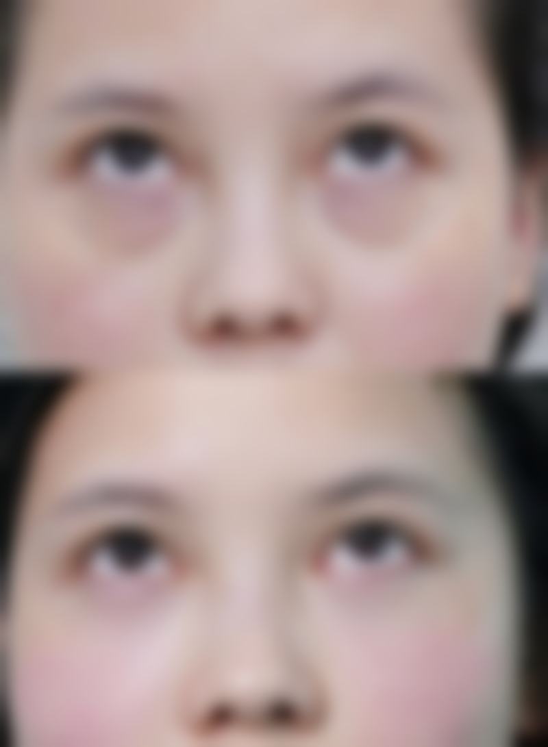 哪些医院能做双眼皮割窄加宽