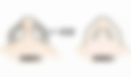 冰敷除掉眼袋背后的科学原理