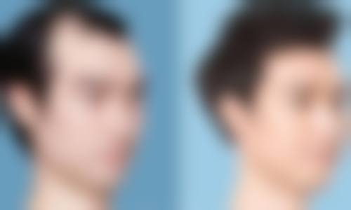 天津伊美尔加禾植发医院价格表