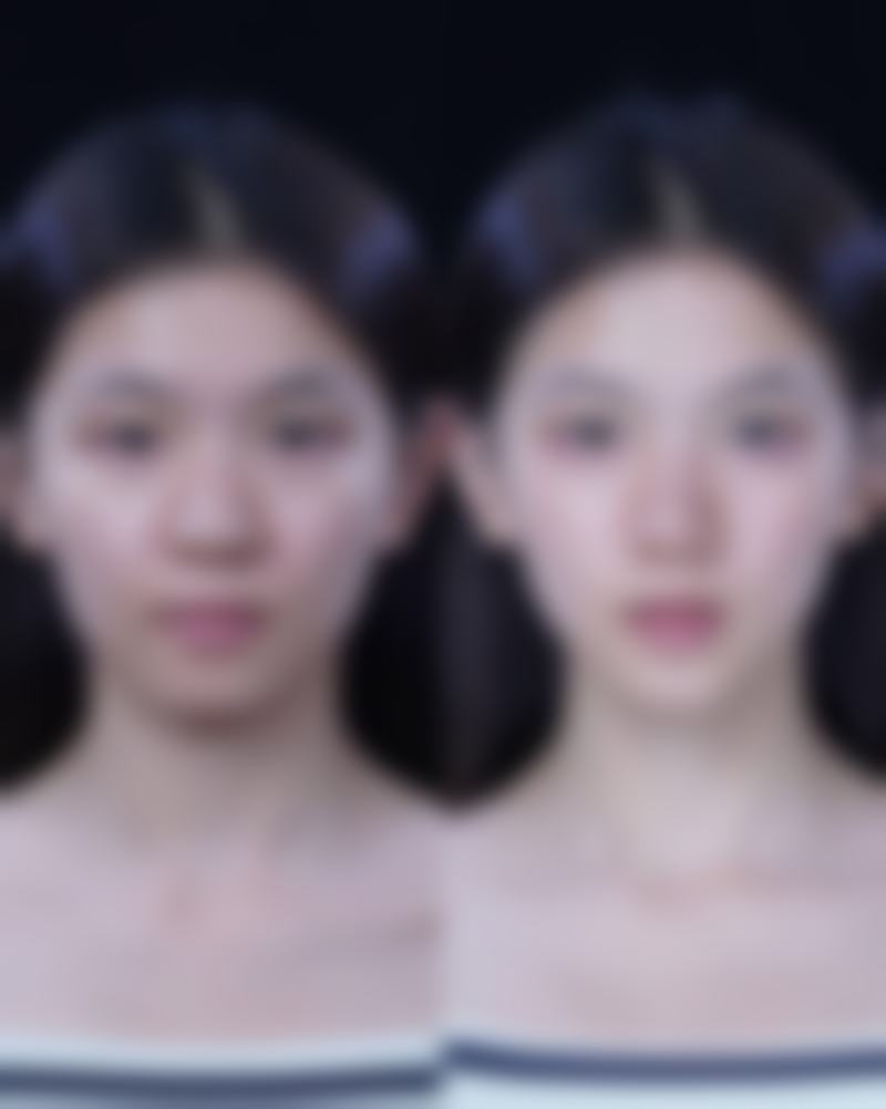 哪些人不适合打除皱针