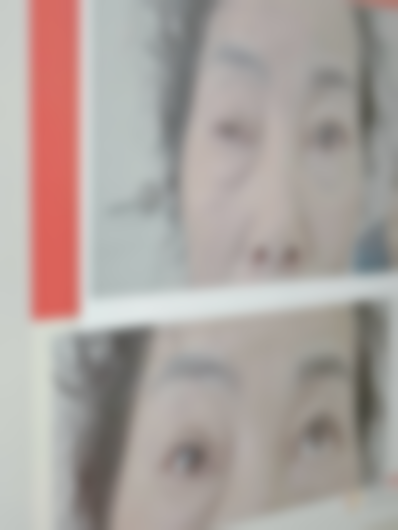 双眼皮拆线后眼角有点小疙瘩怎么办：判断小疙瘩是否需要治疗