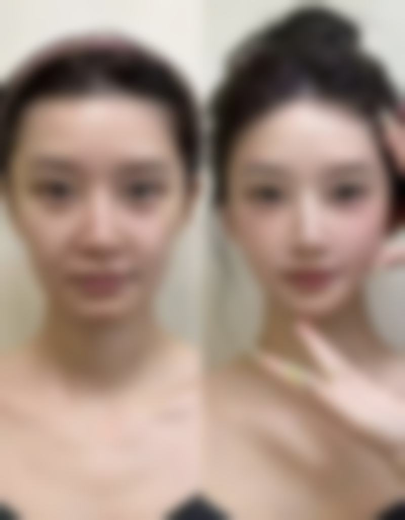 去眼袋什么更好更有效之按摩手法秘籍