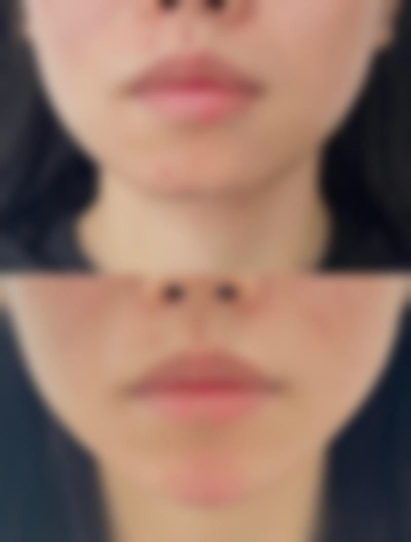 去眼袋什么更好更有效之个性化方案总结