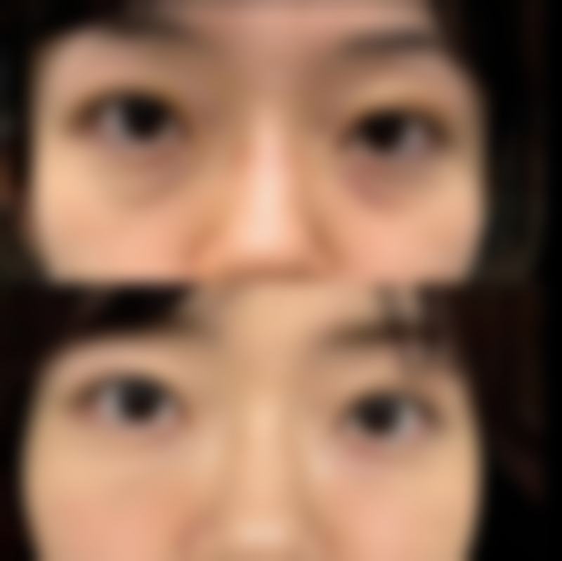 去眼袋什么更好更有效之方法大揭秘