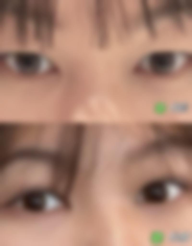 抽脂瘦大腿安心吗——遵循安心的操作流程