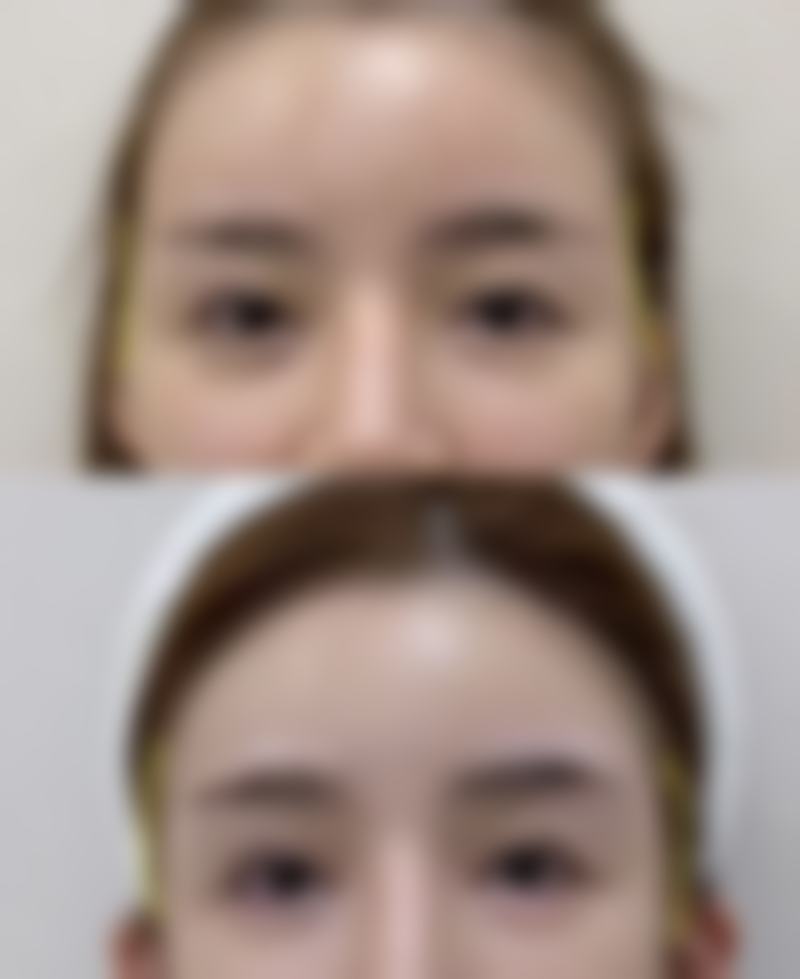 全切双眼皮多久红色线能消失之专精眼科医院隐藏补贴