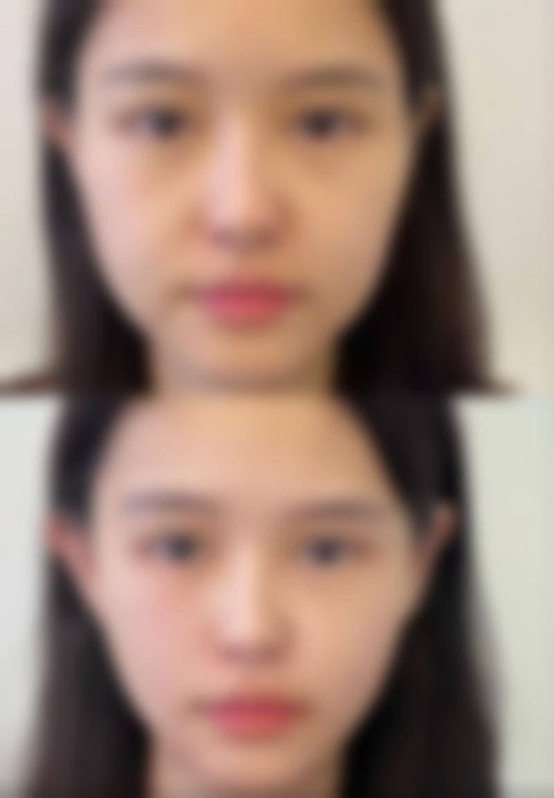 去眼袋什么最好最有效？全国三甲医院榜单+WMP眼霜测评全解析