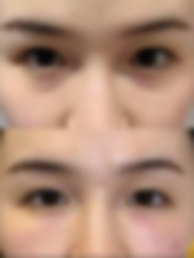 眼袋有泪沟应该怎样去除？医美填充+手术矫正双管齐下告别凹陷