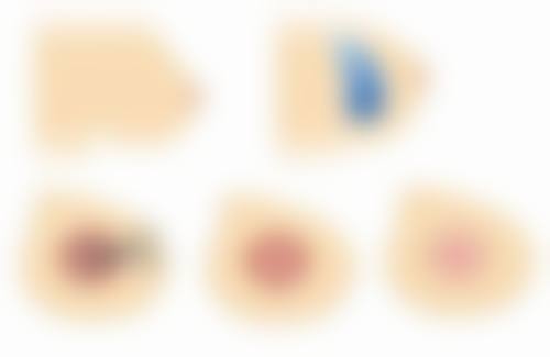 割双眼皮为什么看起来那么假——价格陷阱：便宜没好货，好货不便宜