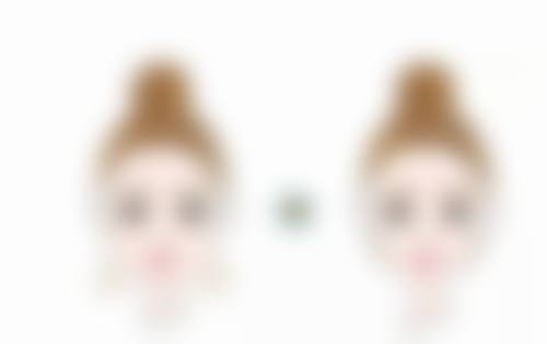 割双眼皮要肿多久？三甲医院微创1个月，全切3-6个月恢复期详解