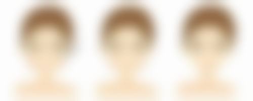 面部青春痘凸起疤痕怎么科学治疗