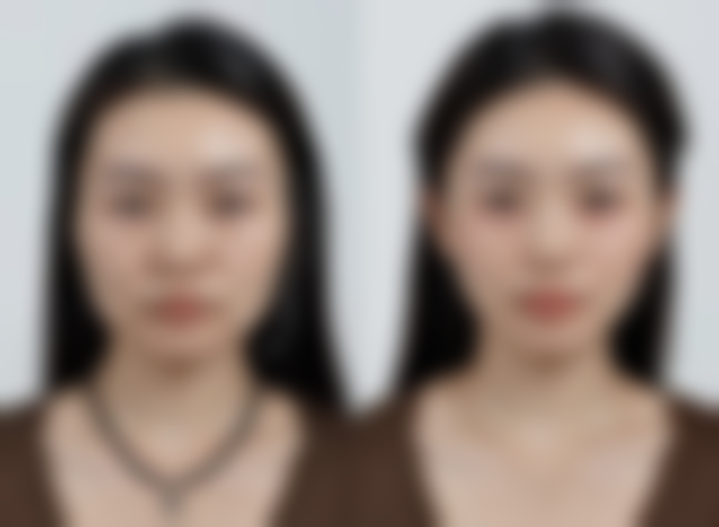 线提升隆鼻:1 - 2 年的“快闪店”能让隆鼻子成效持续吗