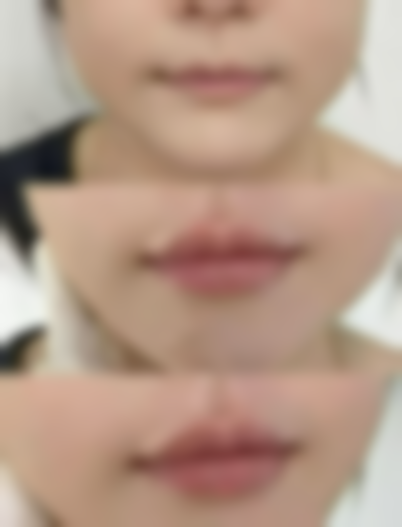 割双眼皮什么样好看之特殊眼型解决方案