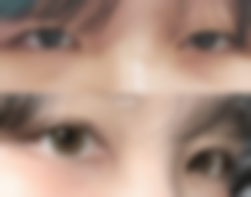 面部青春痘白色疤痕怎么有效改善