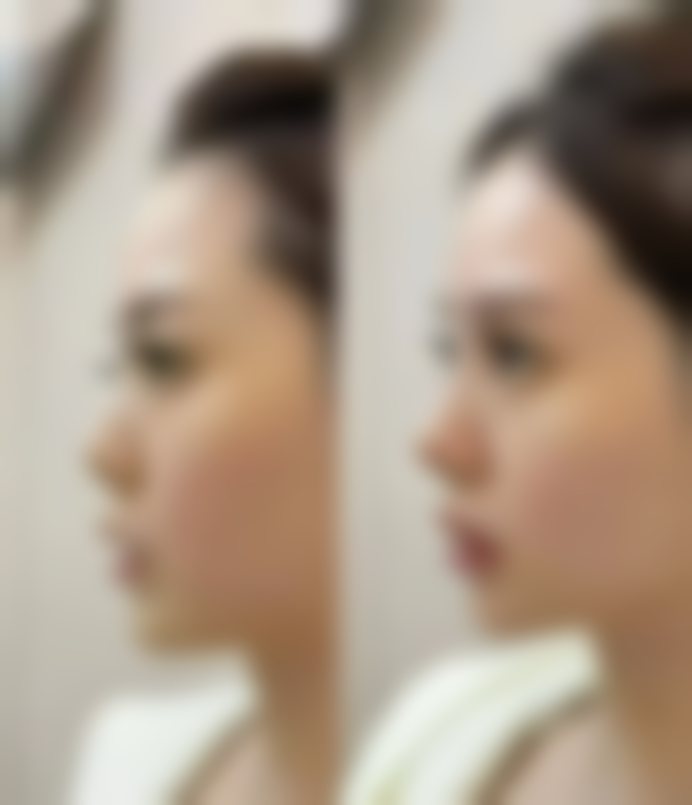 双眼皮埋线肿胀危险吗?——正常肿胀与病理性肿胀精细区分