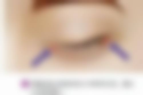 专精整形医院 vs 大型综合医院——谁是肚子吸脂的安心之选