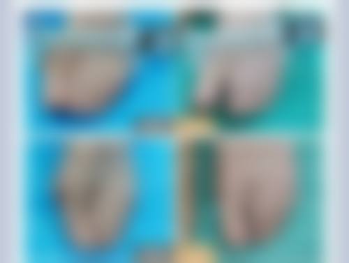 减肥中期对双眼皮手术的影响:风险更高阶段