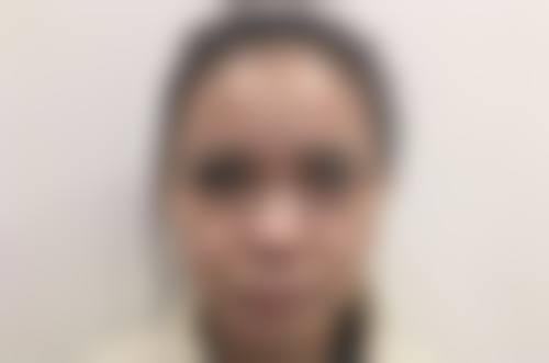 如何平衡减肥与双眼皮手术:皮肤护理不可少