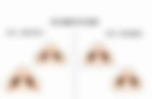 割双眼皮后护理不当多久修复：错误示范敲响警钟