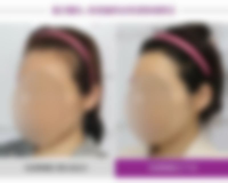 隆胸手术属于大手术吗?选择医院的终极指南