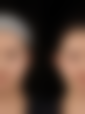 减肥前期对双眼皮手术的影响:是至佳手术时机吗