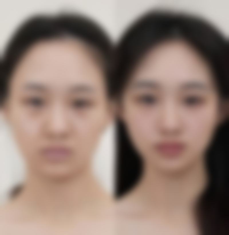 做双眼皮抹百多邦怎样保护消肿环境