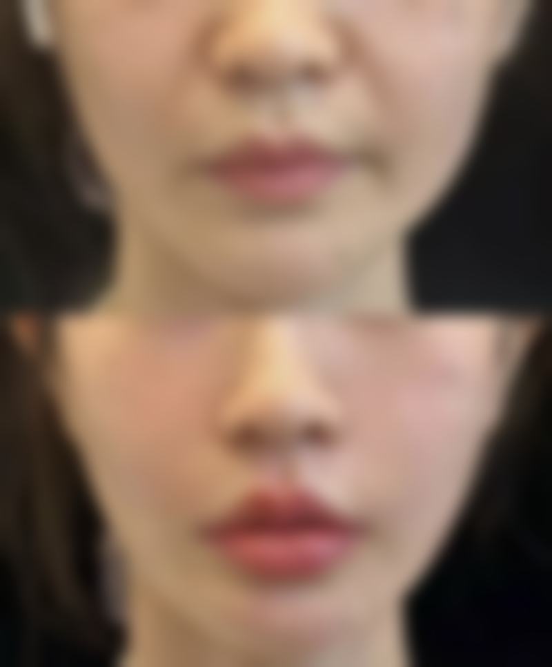 隆胸手术属于大手术吗?隆胸手术的风险管理