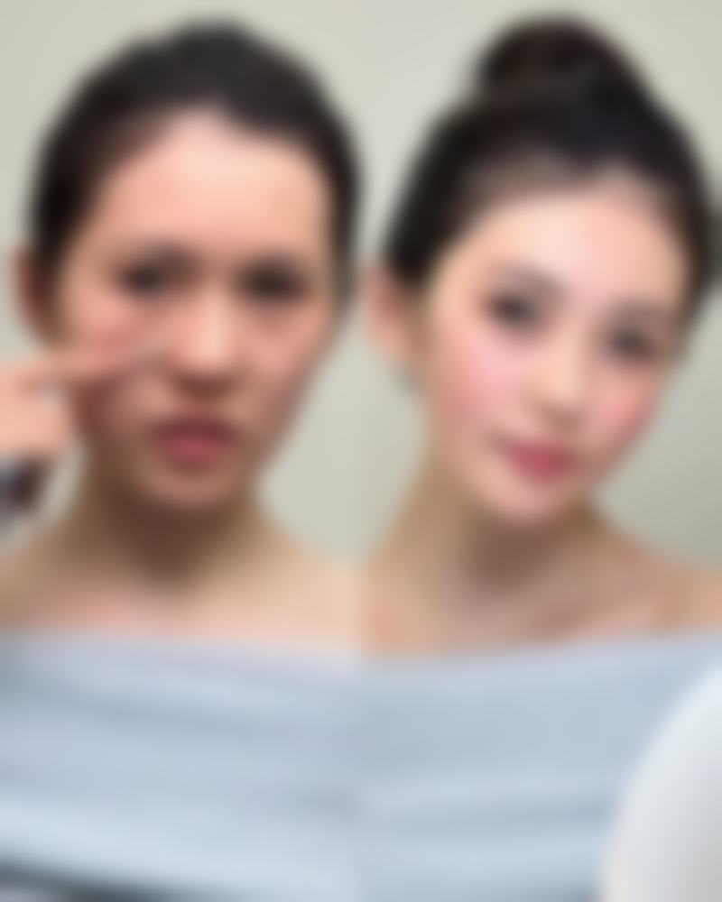 减肥对割双眼皮有影响吗？快速减肥VS缓慢减肥效果大不同