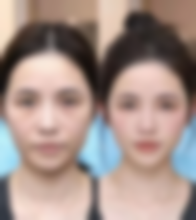 割双眼皮多久能喝豆浆？详细时间表请收好