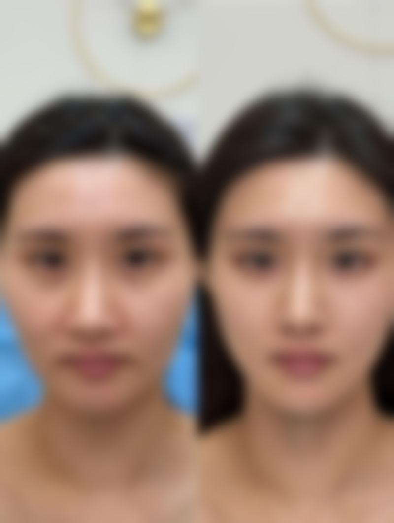 做双眼皮抹红霉素眼膏为何能消肿