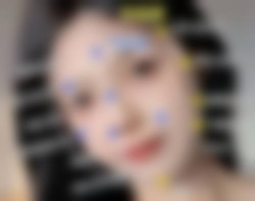 埋线双眼皮以后取线的方法揭秘