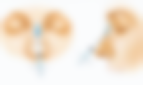 三、割双眼皮肉条形成的原因之瘢痕增生：眼皮上的“小战士”过于积极