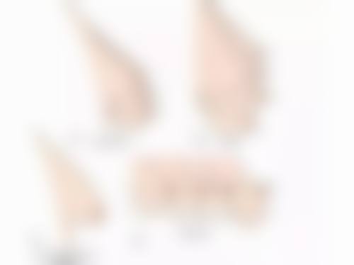 五、割双眼皮肉条手术中怎么形成