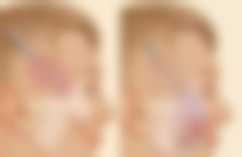 双眼皮割了有后遗症吗——眼部干涩：美丽背后的不适代价