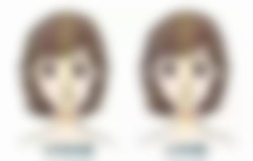 Park双眼皮和其他双眼皮手术对比是什么