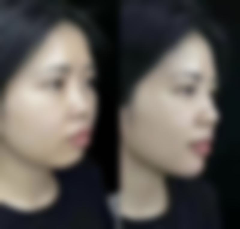 不同年龄段做假体隆胸的风险差异