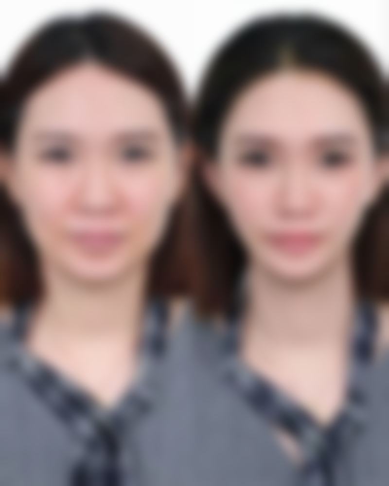 光电治疗疤痕修复避坑指南成效保护怎么样