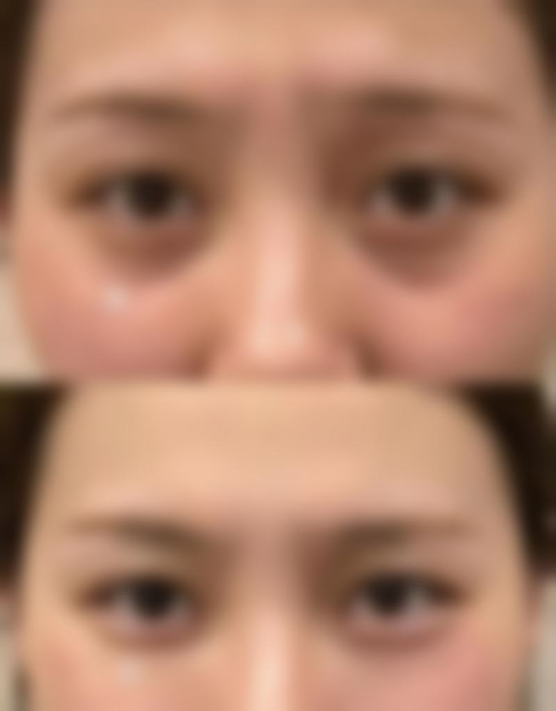 埋线双眼皮以后取线的风险提示