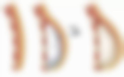 半恒久双眼皮埋线那些不可不知的风险