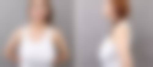 武汉斯启诺医疗美容门诊部董雷手术风格——上海清沁医疗美容门诊部