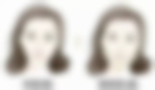 半恒久双眼皮埋线从“肿眼泡”到自然电眼的蜕变