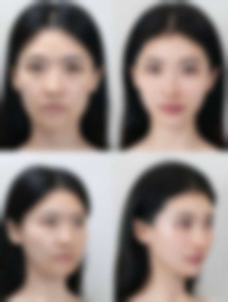 半恒久双眼皮埋线3 - 5年成效的真相