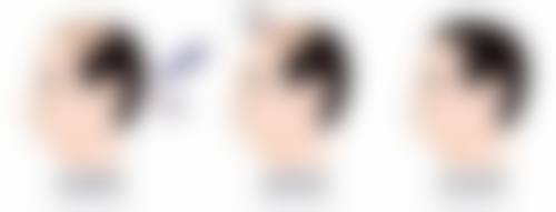 年轻女性什么时候隆胸比较好