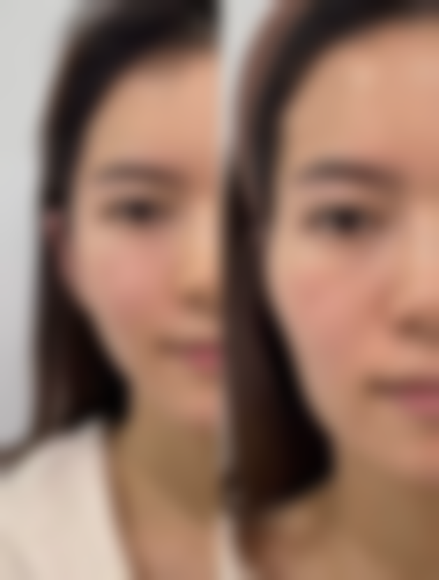 产后女性什么时候隆胸比较好