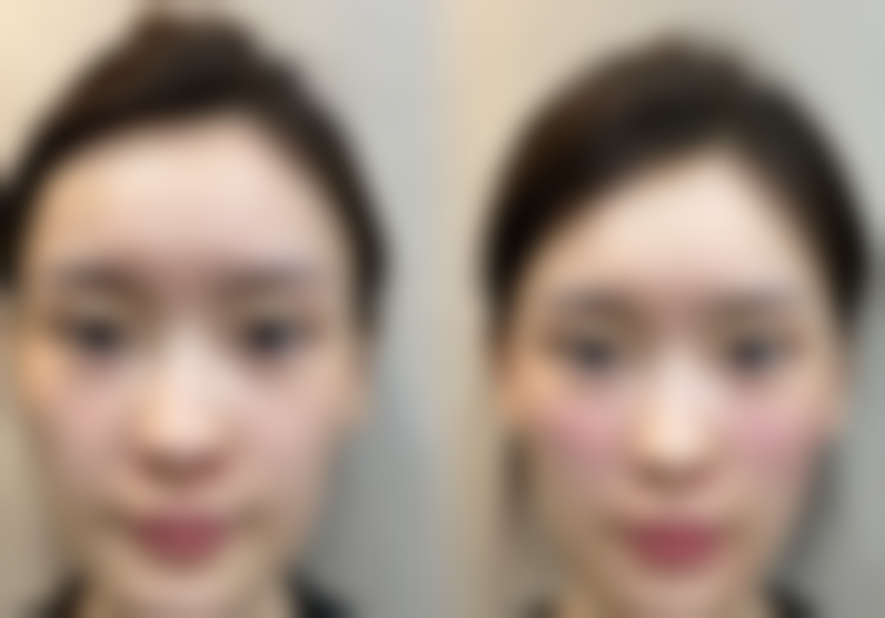 冬季和夏季什么时候隆胸比较好