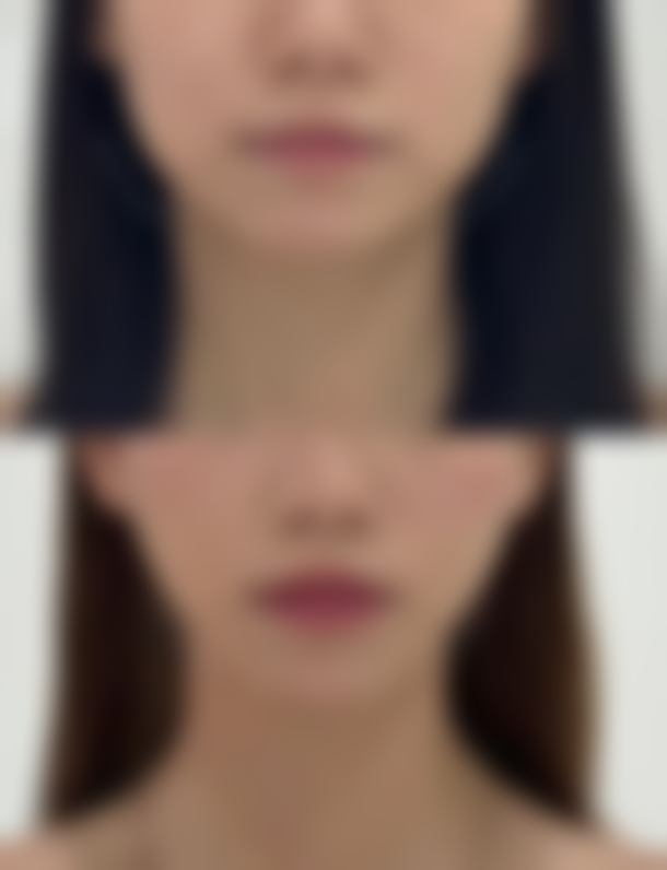 长期的下眼袋怎么去除——非手术医美，成都优质医院无创焕新